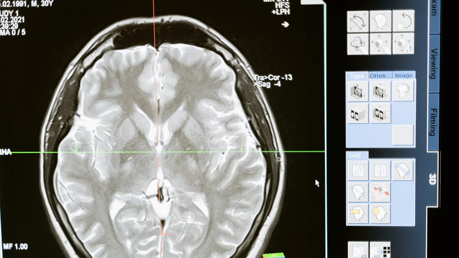 Intricate MRI brain scan displayed on a computer screen for medical analysis and diagnosis.